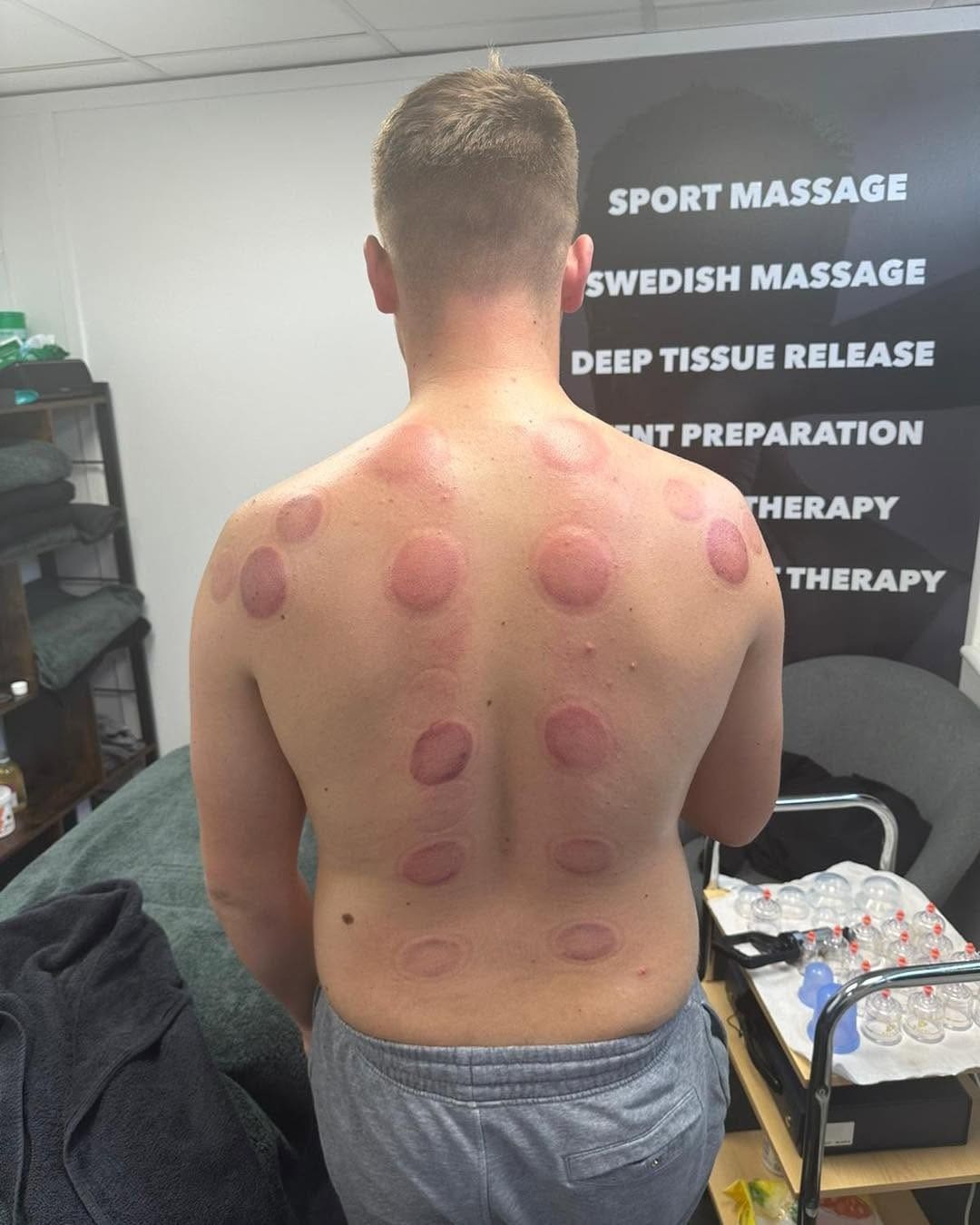 Client's back after a cupping session at The Recovery Room, with the treatments banner behind