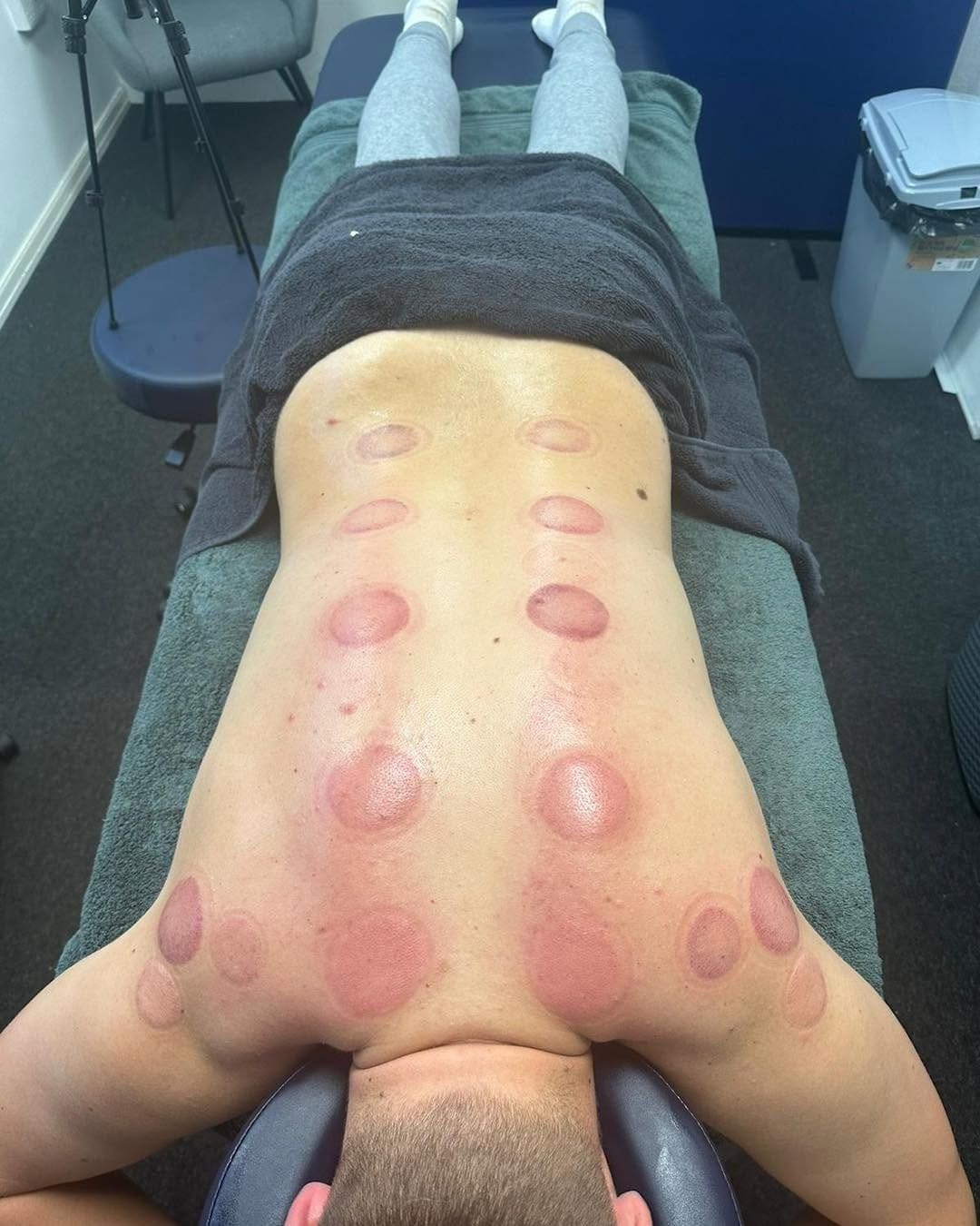 Client lying on the treatment table after cupping therapy